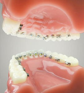 Lingual braces are applied to the back of your teeth - Crawley Dentist